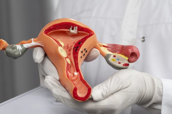 Fibroid