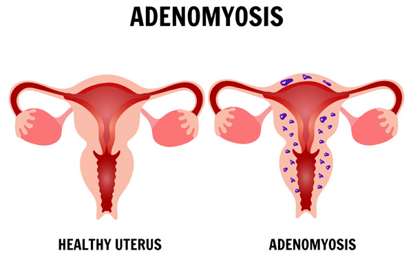Adenomyosis