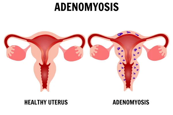 Adenomyosis