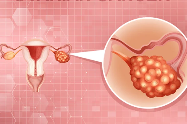 Cyst in Ovary